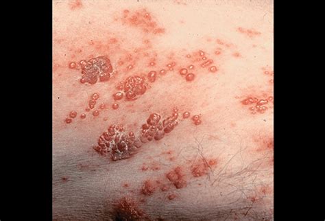 varicella zoster virus infection icd 10